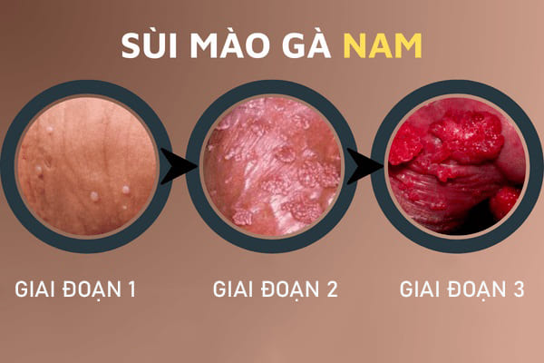 bieu-hien-sui-mao-ga-o-nam