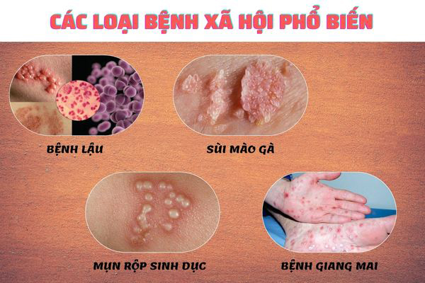 xét nghiệm mụn rộp sinh dục - 2