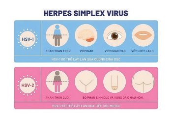 Chữa Herpes bằng phương pháp nào hiệu quả?