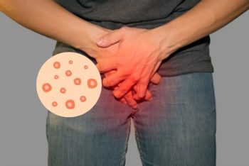 Herpes nam giới là bệnh gì nguy hiểm không?