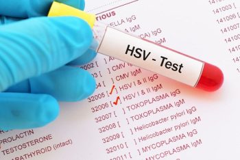 Chi phí xét nghiệm Herpes bao nhiêu?