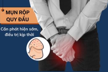 Cách điều trị mụn rộp quy đầu hiệu quả và an toàn