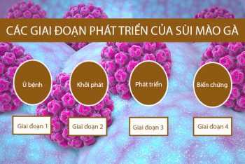 Các giai đoạn sùi mào gà từ nhẹ đến nặng