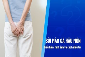 Sùi mào gà hậu môn: Nguyên nhân và cách điều trị