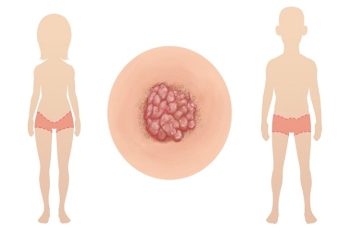 Phương pháp chữa sùi mào gà bộ phận sinh dục hiện đại