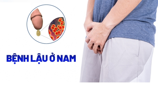 dau-hieu-benh-lau-o-nam