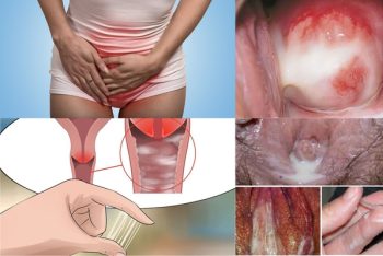 7 dấu hiệu bệnh lậu ở nữ giới dễ bị bỏ qua – Đọc ngay kẻo muộn!