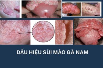 Dấu hiệu sùi mào gà nam và cách điều trị