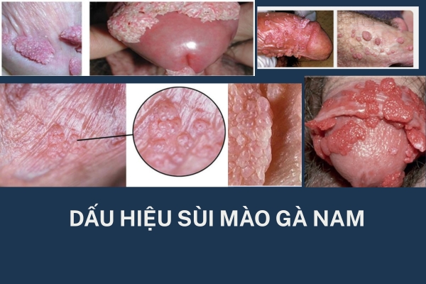 dau-hieu-sui-mao-ga-nam (1)