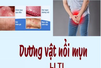Dương vật nổi mụn li ti: Coi chừng “dính” bệnh xã hội mà không hay!