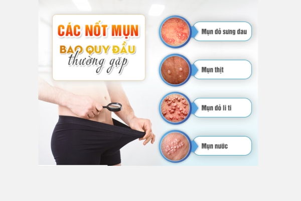 mun-bao-quy-dau