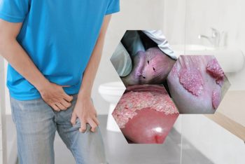 Dấu hiệu sùi mào gà đầu cu là bệnh gì nguy hiểm không?