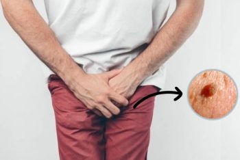 Triệu chứng sùi mào gà ở dái nam giới cần phát hiện sớm
