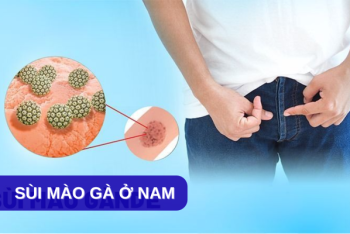 Địa chỉ điều trị sùi mào gà ở nam uy tín, kín đáo